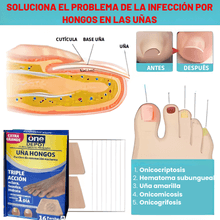 Pack x3 - Parches para el Cuidado de las Uñas 🦶🏼💅🏼  | Discretos, Prácticos y de Uso Diario